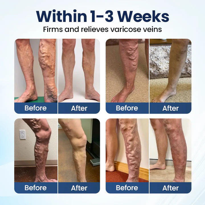 Timilk® Deep Vein Repair Microneedle Patch