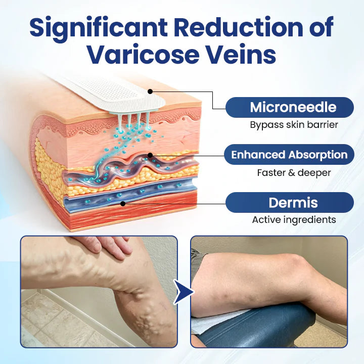 Timilk® Deep Vein Repair Microneedle Patch